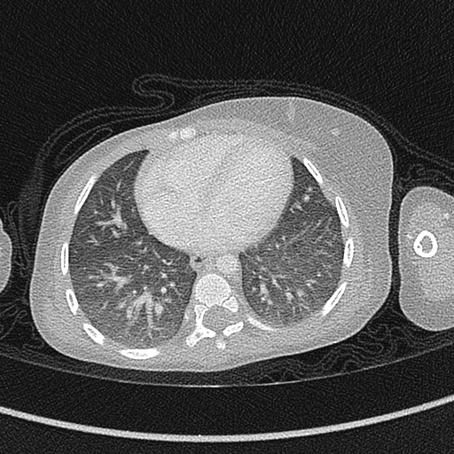 File:Beckwith-Wiedeman syndrome with bilateral Wilms tumors (Radiopaedia 60850-68629 Axial lung window 43).jpg