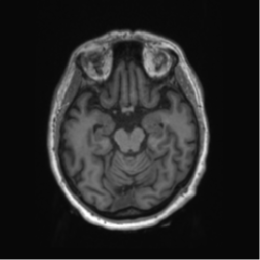 Behavioral variant frontotemporal dementia and late onset schizophrenia (Radiopaedia 52197-58083 Axial T1 68).png