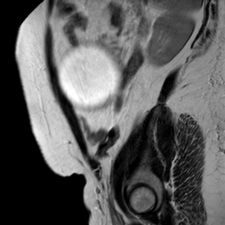 File:Benign seromucinous cystadenoma of the ovary (Radiopaedia 71065-81300 Sagittal T2 3).jpg
