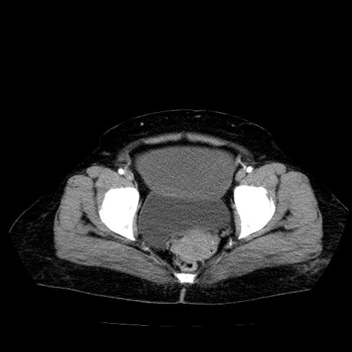Benign spindle cell tumor - abdominopelvic (Radiopaedia 61300-69212 A 55).jpg