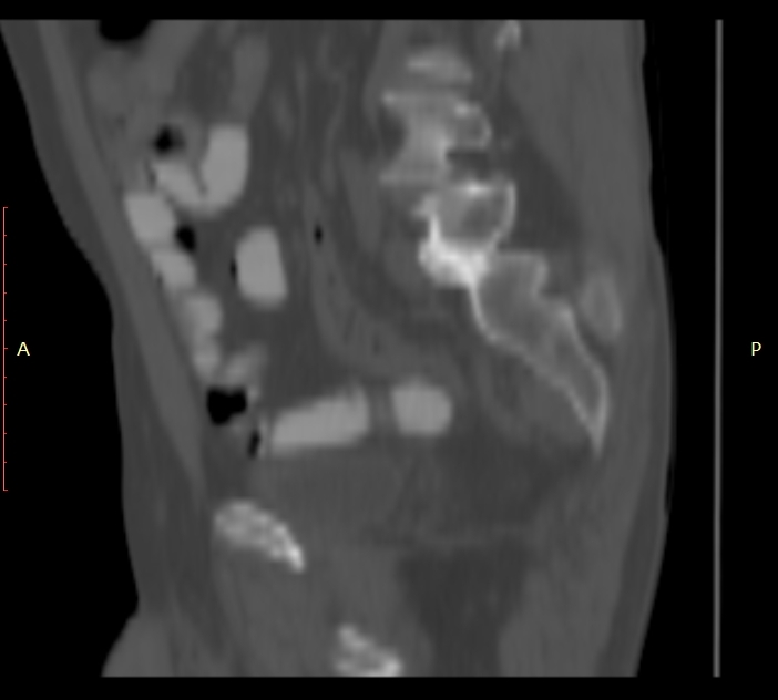 Bertolotti syndrome (Radiopaedia 58974-66235 Sagittal bone window 41).jpg