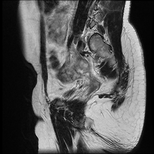 File:Bicornuate uterus (Radiopaedia 51676-57472 Sagittal T2 19).jpg