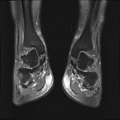 File:Bilateral Achilles tendon complete tear (Radiopaedia 81344-95051 Coronal PD fat sat 14).jpg