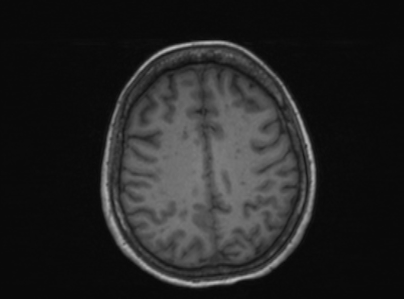 File:Bilateral PCA territory infarction - different ages (Radiopaedia 46200-51784 Axial T1 183).jpg