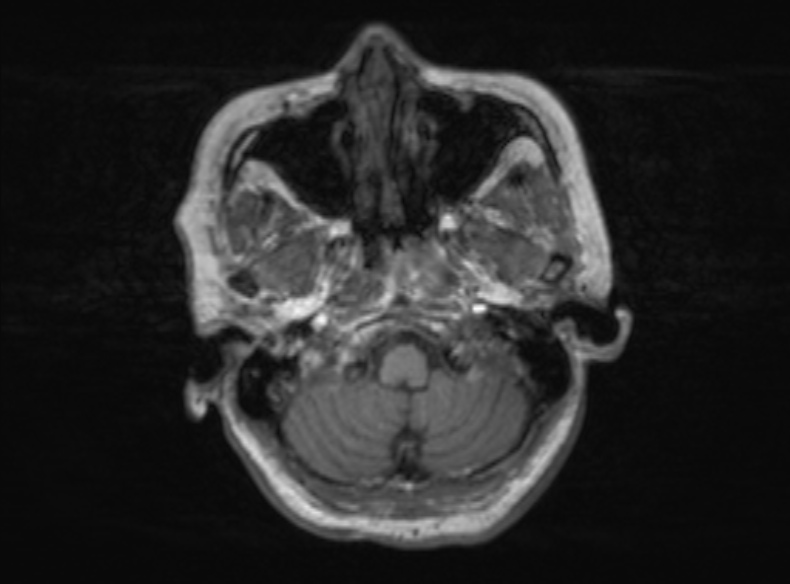 Bilateral PCA territory infarction - different ages (Radiopaedia 46200-51784 Axial T1 334).jpg