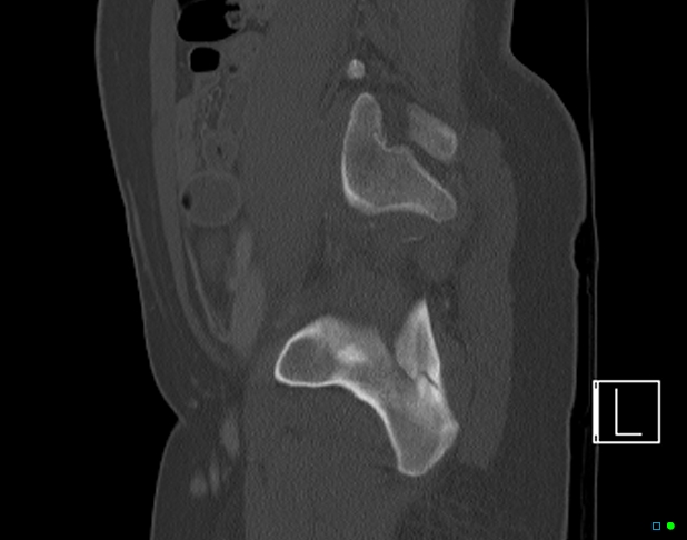 File:Bilateral acetabular fractures (Radiopaedia 79272-92308 Sagittal bone window 60).jpg
