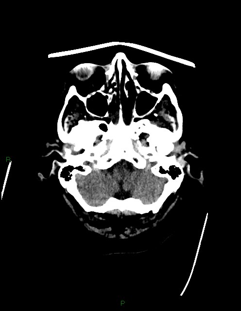 Bilateral acute middle cerebral artery territory infarcts (Radiopaedia 77319-89401 Axial non-contrast 11).jpg