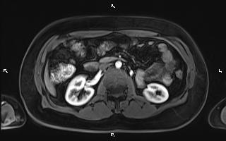 Bilateral adrenal myelolipoma (Radiopaedia 63058-71537 Axial T1 C+ fat sat 51).jpg