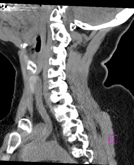 Bilateral atlanto-occipital assimilation (Radiopaedia 28350-28603 D 31).jpg