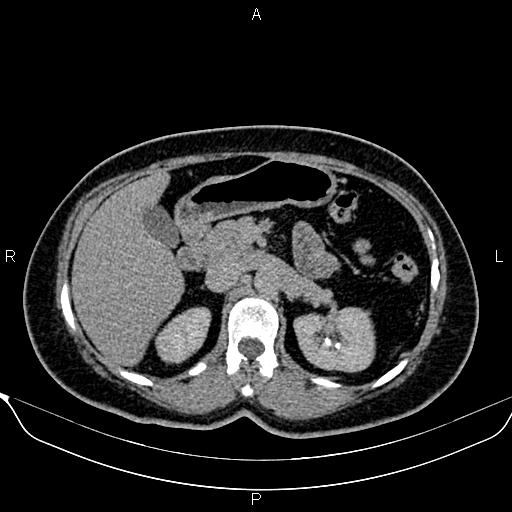 Bilateral benign adrenal adenomas (Radiopaedia 86912-103124 Axial C+ delayed 43).jpg