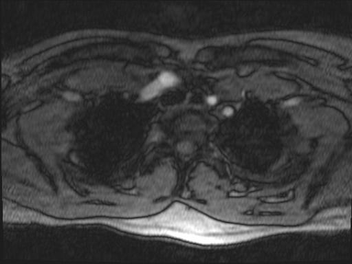 Bilateral carotid body tumors and right glomus jugulare tumor (Radiopaedia 20024-20060 Axial MRA 177).jpg