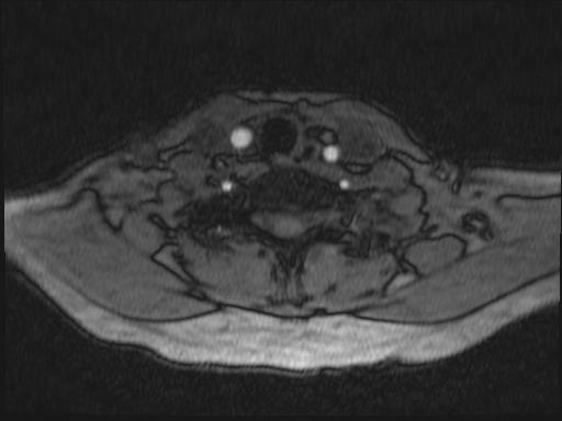 Bilateral carotid body tumors and right glomus jugulare tumor (Radiopaedia 20024-20060 Axial MRA 200).jpg