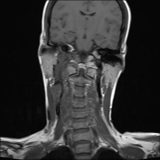 File:Bilateral carotid body tumors and right jugular paraganglioma (Radiopaedia 20024-20060 Coronal 12).jpg