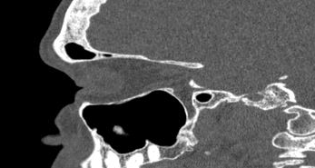 File:Bilateral ectopic infraorbital nerves (Radiopaedia 49006-54084 Sagittal 22).png