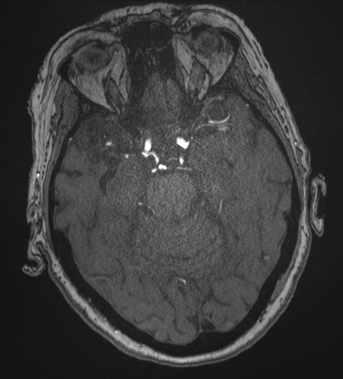 Bilateral fetal posterior communicating arteries (Radiopaedia 41286-44102 Axial MRA 73).png
