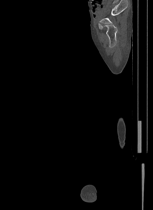 Bilateral fibular hemimelia type II (Radiopaedia 69581-79491 Sagittal bone window 36).jpg