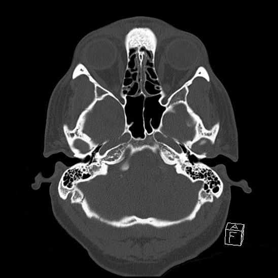 Bilateral occipital condyle fracture (type 2) (Radiopaedia 87675-104089 Axial bone window 25).jpg