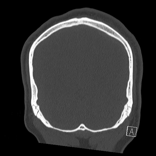 Bilateral occipital condyle fracture (type 2) (Radiopaedia 87675-104089 Coronal bone window 122).jpg