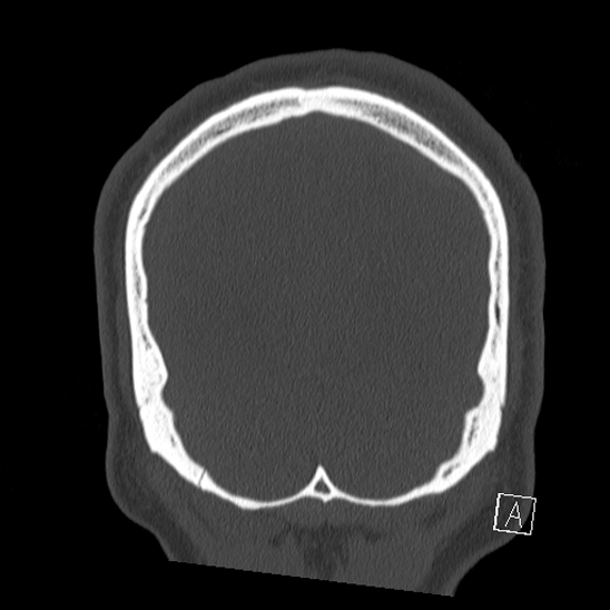 Bilateral occipital condyle fracture (type 2) (Radiopaedia 87675-104089 Coronal bone window 129).jpg