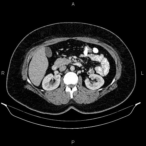 File:Bilateral ovarian dermoid cysts (Radiopaedia 85785-101603 A 45).jpg