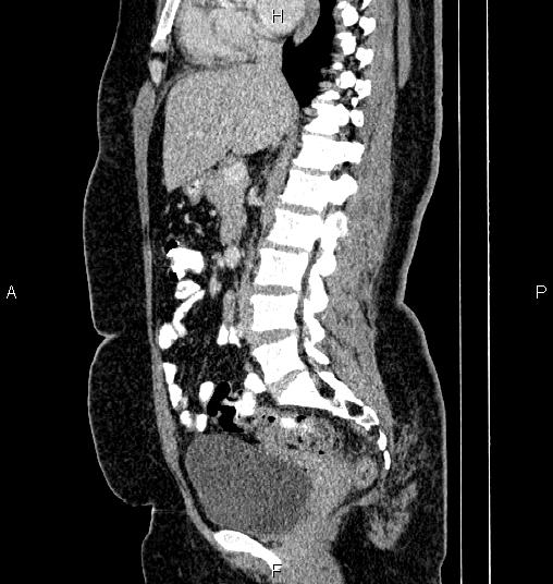 Bilateral ovarian dermoid cysts (Radiopaedia 85785-101603 D 42).jpg