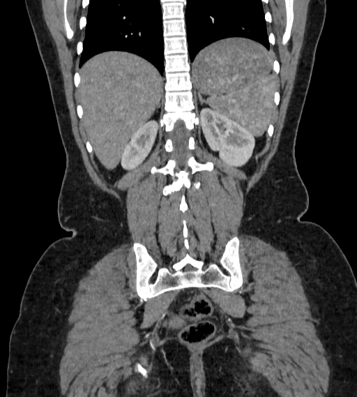 Bilateral ovarian mature cystic teratomas (Radiopaedia 79373-92457 B 79).jpg