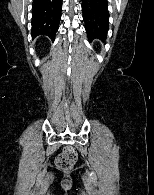 Bilateral ovarian serous cystadenocarcinoma (Radiopaedia 86062-101989 D 48).jpg