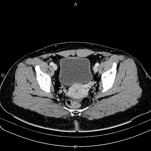 File:Bilateral ovarian teratoma (Radiopaedia 83131-97503 Axial With contrast 54).jpg