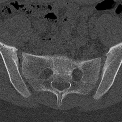 Bilateral pars defect (Radiopaedia 26691-26846 Axial bone window 93).jpg