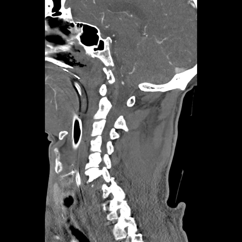 Bilateral perched facets with cord injury (Radiopaedia 45587-49713 B 20).jpg