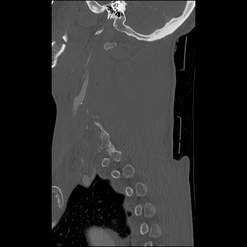 Bilateral perched facets with cord injury (Radiopaedia 45587-49713 Sagittal bone window 43).jpg