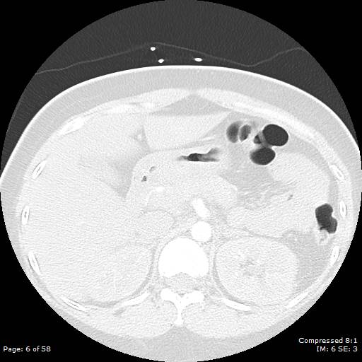 Bilateral pulmonary emboli with Hampton hump sign (Radiopaedia 54070-60246 Axial lung window 6).jpg