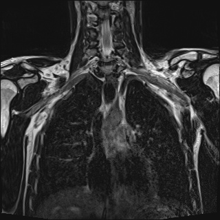 Bilateral spinoglenoid notch ganglion cysts (Radiopaedia 29577-30082 Coronal T2 56).jpg