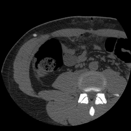 Bile leak from liver traumatic laceration (Radiopaedia 63463-72077 Axial Biliscopin 88).jpg
