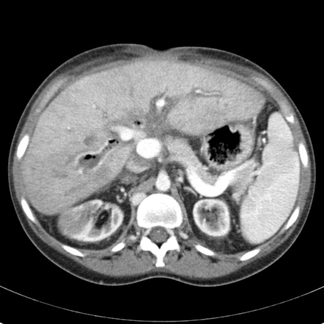 Biliary necrosis - liver transplant (Radiopaedia 21876-21846 B 24).jpg