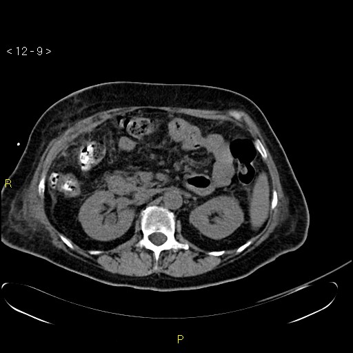 File:Biloma with drainage into the colon (Radiopaedia 20032-20068 B 18).jpg