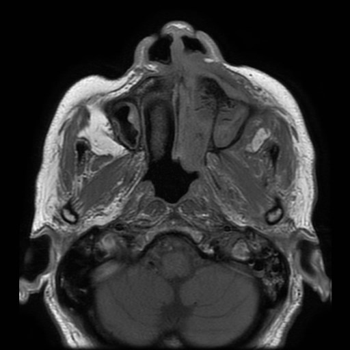 Bisphosphonate-related osteonecrosis of the maxilla (Radiopaedia 51367-57101 Axial T1 27).jpg