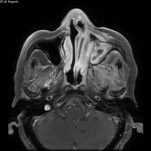 Bisphosphonate-related osteonecrosis of the maxilla (Radiopaedia 51367-57101 Axial T1 C+ fat sat 26).jpg