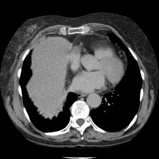 Bladder tumor detected on trauma CT (Radiopaedia 51809-57609 C 8).jpg