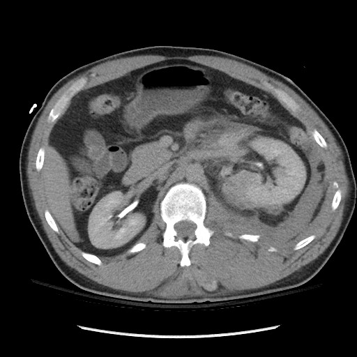 Blunt abdominal trauma with solid organ and musculoskelatal injury with active extravasation (Radiopaedia 68364-77895 Axial C+ delayed 53).jpg