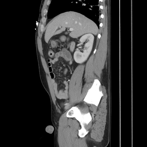 File:Blunt abdominal trauma with solid organ and musculoskelatal injury with active extravasation (Radiopaedia 68364-77895 C 55).jpg