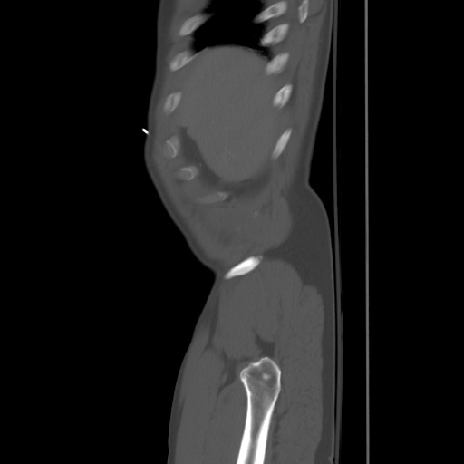 Blunt abdominal trauma with solid organ and musculoskelatal injury with active extravasation (Radiopaedia 68364-77895 Sagittal bone window 1).jpg