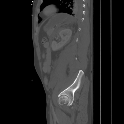 Blunt abdominal trauma with solid organ and musculoskelatal injury with active extravasation (Radiopaedia 68364-77895 Sagittal bone window 79).jpg