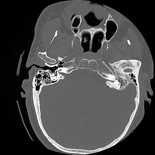 File:Blunt cerebrovascular injury (Radiopaedia 53682-59743 Axial bone window 5).png