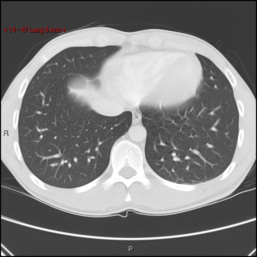 File:Blunt chest trauma - pulmonary interstitial emphysema and pneumomediastinum (Radiopaedia 20666-20552 Axial lung window 47).jpg