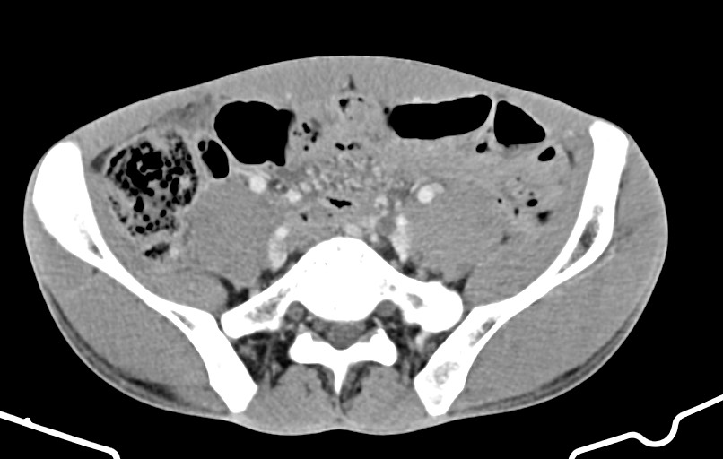 Blunt injury to the small bowel (Radiopaedia 74953-85987 A 138).jpg