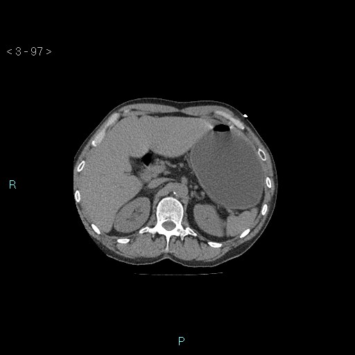 File:Boerhaave syndrome (Radiopaedia 27683-27897 Axial non-contrast 97).jpg