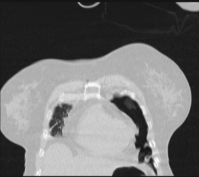 Boerhaave syndrome (Radiopaedia 45644-49799 Coronal lung window 12).jpg