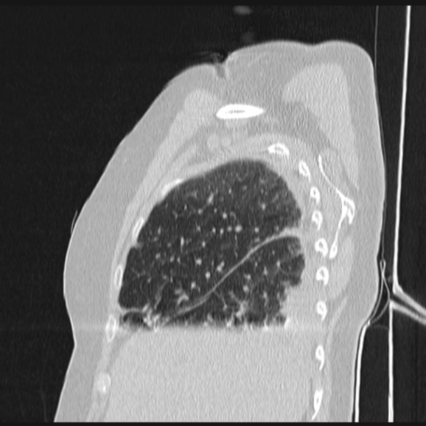 Boerhaave syndrome (Radiopaedia 45644-49799 Sagittal lung window 16).jpg