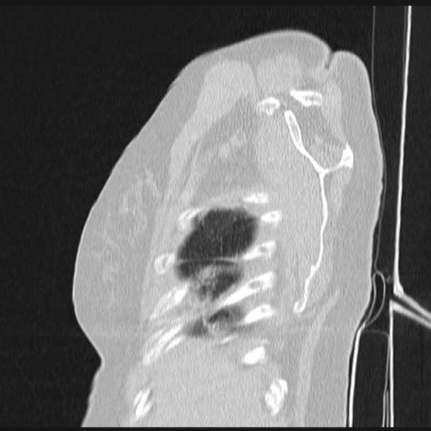 Boerhaave syndrome (Radiopaedia 45644-49799 Sagittal lung window 6).jpg